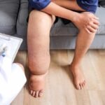 Mass Drug Administration (MDA) of Ivermectin, DEC & Albendazole (MDA/IDA)