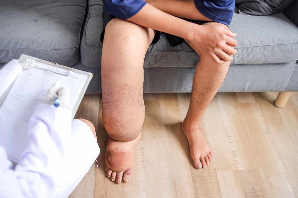 Lymphatic Filariasis