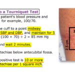Effective Vector Control Measures for Dengue Fever Prevention