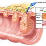 Colorectal Cancer: Causes, Symptoms & Stages