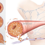 Breast Cancer: Symptoms, Stages, Risk Factors, Screening & Treatment