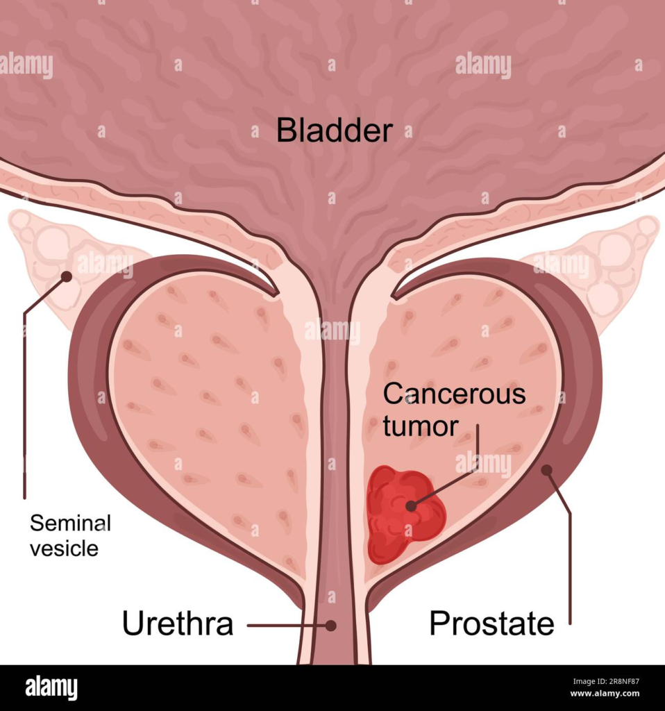 Prostate Cancer
