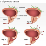 Prostate Cancer: Symptoms, Causes, Diagnosis, Treatment & Survival Rates