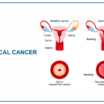 Skin Cancer: Types, Causes, Symptoms, Prevention & Treatment