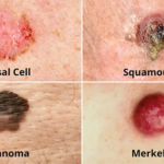 Skin Cancer: Types, Causes, Symptoms, Prevention & Treatment