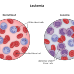 Bone Cancer: Types, Symptoms, Diagnosis, Treatment & Awareness