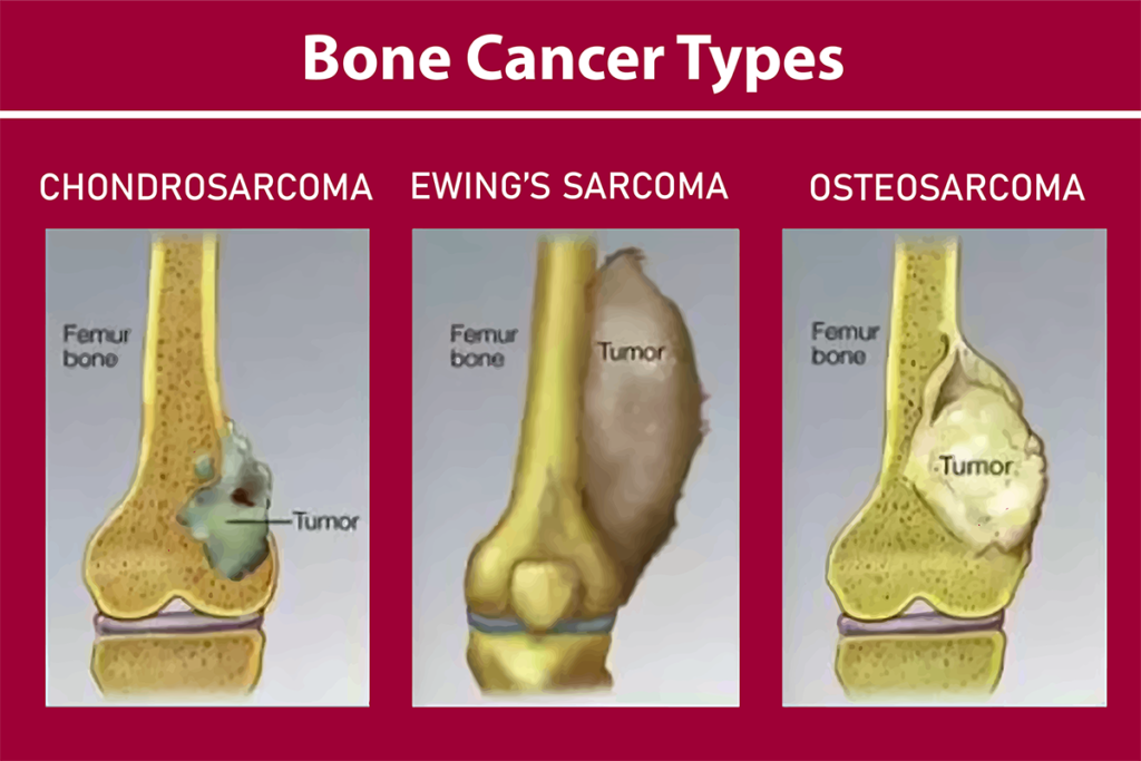 Bone Cancer