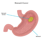 Colorectal Cancer: Causes, Symptoms & Stages