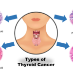 Thyroid Cancer: Types, Symptoms, Risk Factors, Treatment & Survival