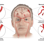 Brain Stroke: Types, Causes, Symptoms, Treatment & Prevention