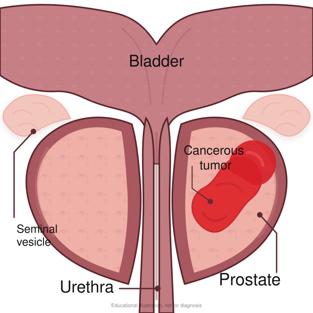 Prostate Cancer