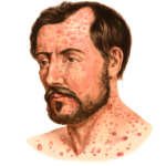 Treponema Pallidum: Structure and Life Cycle Of Syphilis