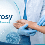 Leprosy: 5 Critical Facts on Hansen’s Disease & MDT